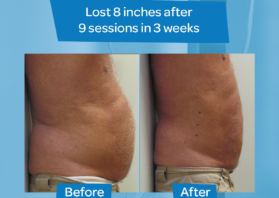Man abdomen before after 8 inch loss 9 sessions 3 weeks