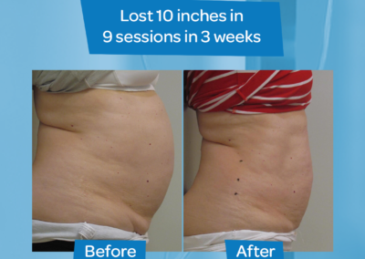 Woman abdomen before after 10 inch loss 9 sessions 3 weeks