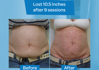 Woman abdomen before after 10.5 inch loss 9 sessions