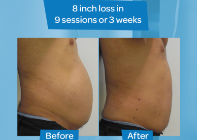 Man Abdomen before after 8 inch loss 9 sessions 3 weeks