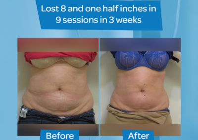 Woman abdomen before after 8.5 inch loss 9 sessions 3 weeks