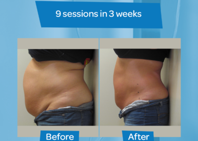 woman stomach before after 9 sessions 3 weeks