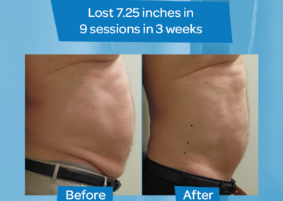 Man abdomen before after 9 sessions 3 weeks