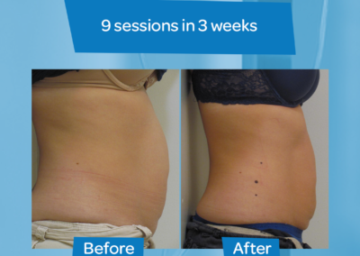 Woman abdomen before after 9 sessions 3 weeks