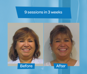 Before After Chin 9 sessions 3 weeks