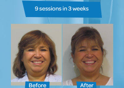 Before After Chin 9 sessions 3 weeks