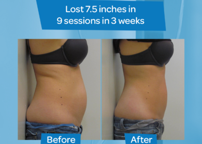 woman abdomen 7.5inch loss 9 sessions 3 weeks