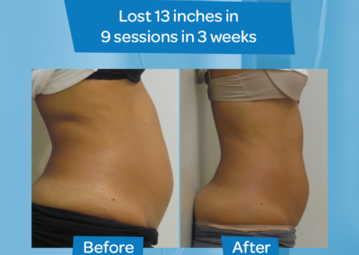 Woman Abdomen before after 9 sessions 3 weeks
