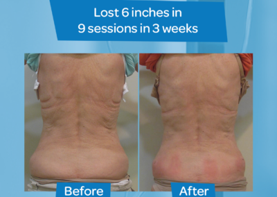 Older woman before after 9 sessions 3 weeks