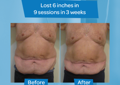 man stomach before after 9 sessions 3 weeks