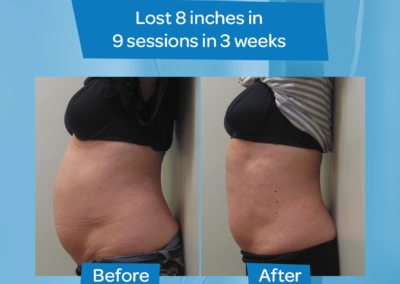 woman abdomen before after 9 sessions 3 weeks