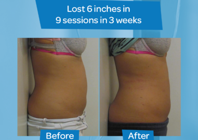 woman flat stomach 6 inch loss 9 sessions 3 weeks