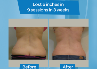 woman waist before after 6 inch loss 9 sessions 3 weeks