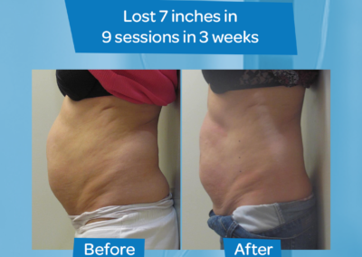 woman abdomen 7 inch loss 9 sessions 3 weeks