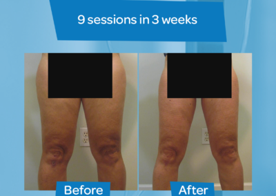woman thigh before after 9 sessions 3 weeks