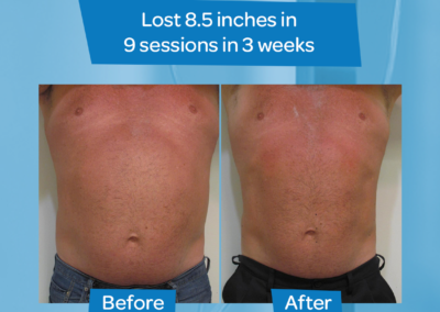 Man abdomen 8.5 inch loss 9 sessions 3 weeks