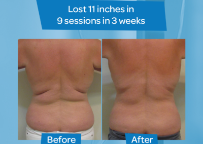 11 inch loss 9 sessions 3 weeks